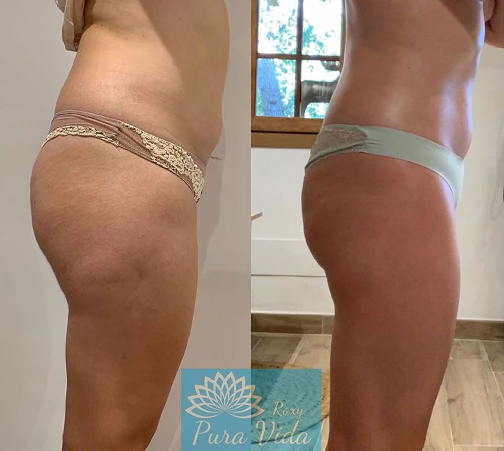 Sapphire Bellaction Duo Body & Face Remodeling Anti Cellulite Behandlung Beine Bauch