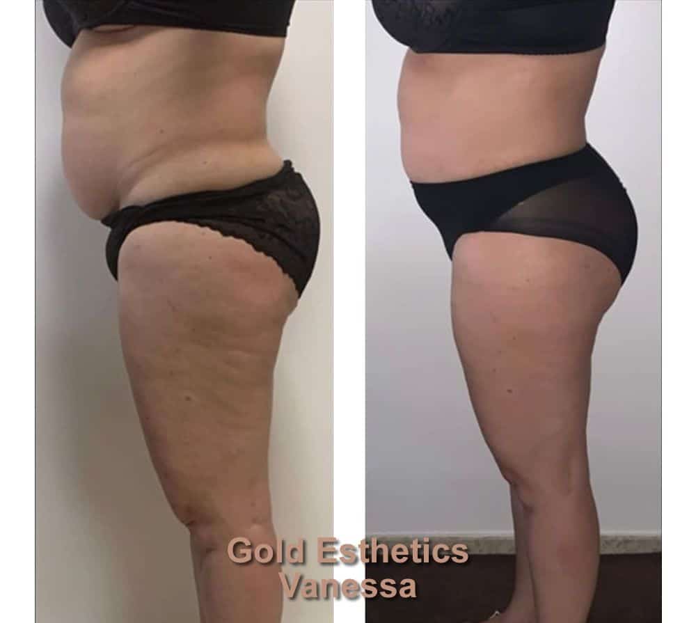Sapphire Bellaction Duo Body & Face Remodeling Anti Cellulite Behandlung Beine Bauch 2