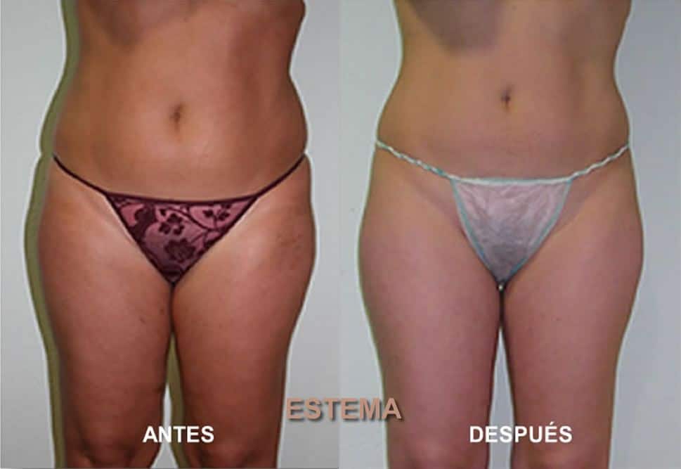 Sapphire Bellaction Duo Body & Face Remodeling Anti Cellulite Behandlung Beine Bauch 3