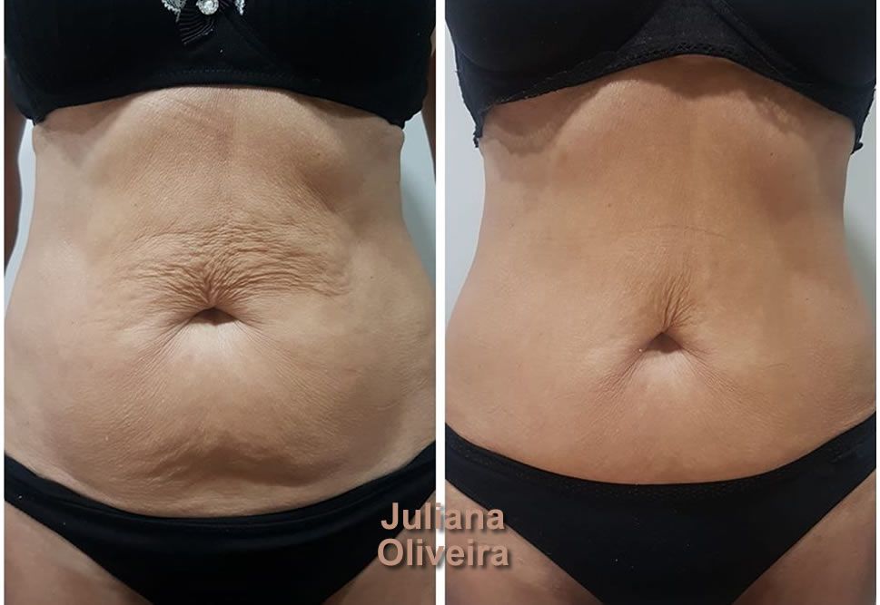 Sapphire Bellaction Duo Body & Face Remodeling Anti Cellulite Behandlung Bauch