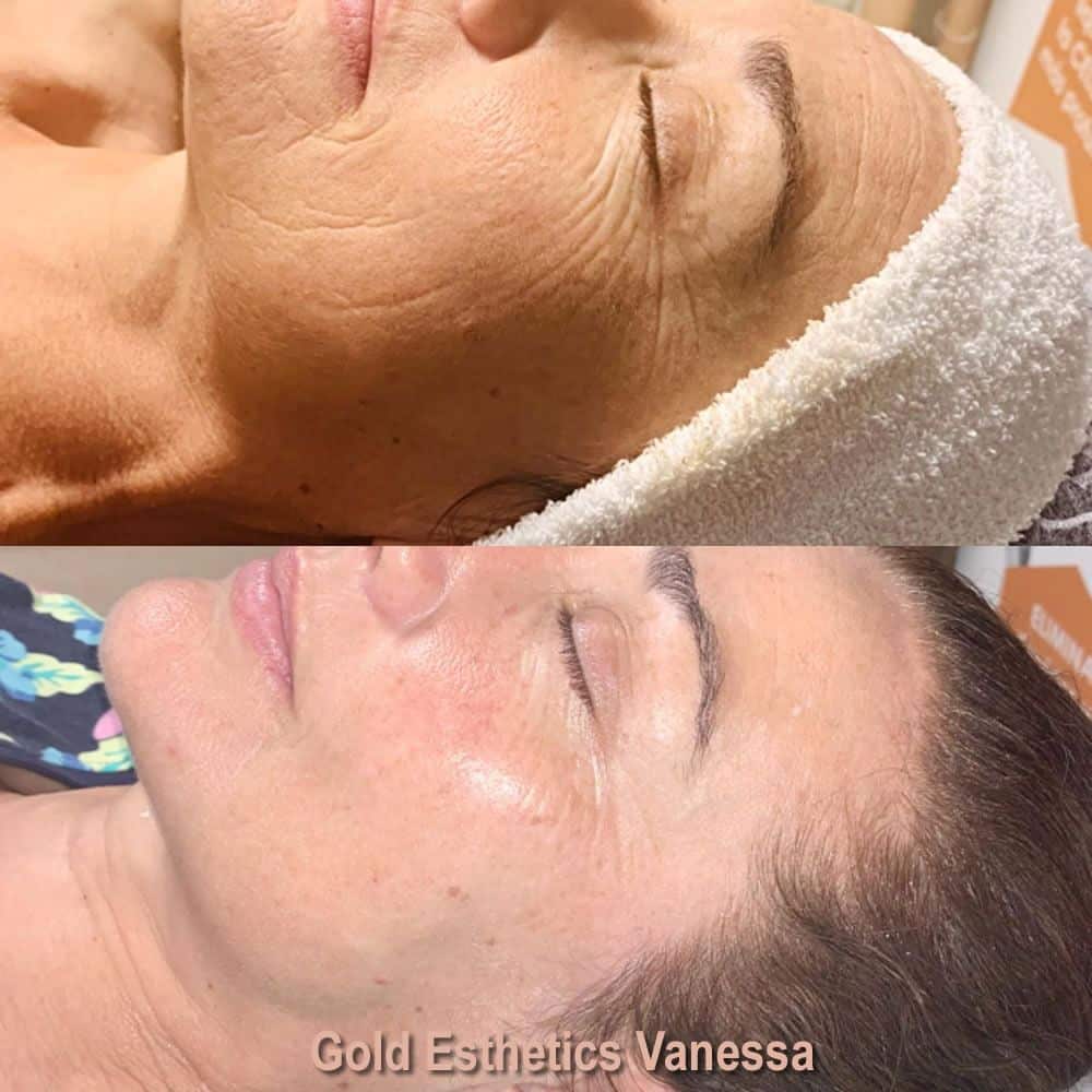 Sapphire Bellaction Duo Body & Face Remodeling Anti Cellulite Behandlung Gesicht
