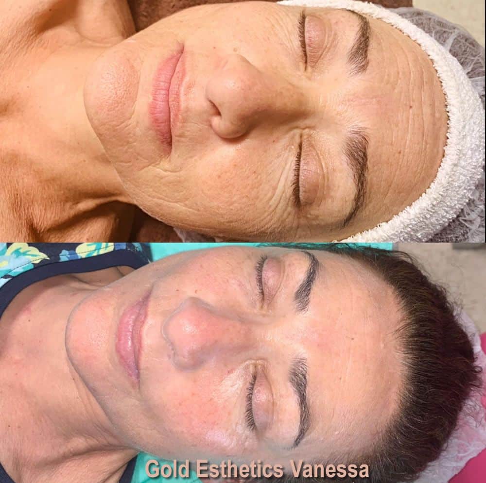 Sapphire Bellaction Duo Body & Face Remodeling Anti Cellulite Behandlung Gesicht 2