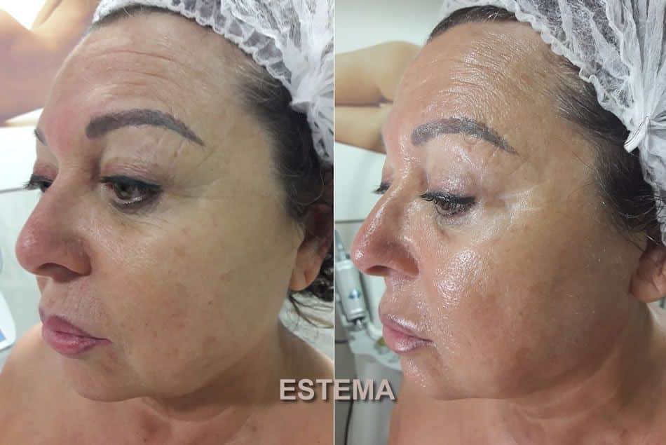 Sapphire Bellaction Duo Body & Face Remodeling Anti Cellulite Behandlung Gesicht