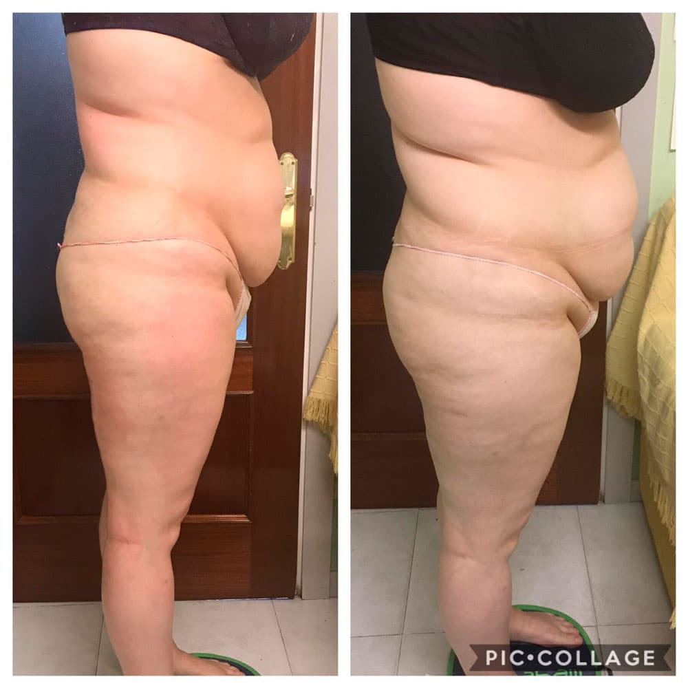 Sapphire Bellaction Duo Body & Face Remodeling Anti Cellulite Behandlung Gesäß Beine Bauch 2