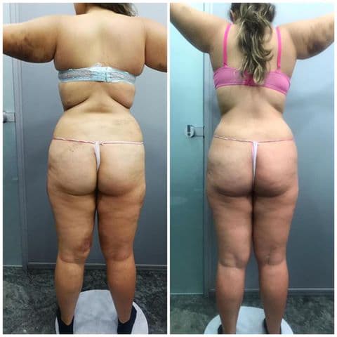 Sapphire Bellaction Duo Body & Face Remodeling Anti Cellulite Behandlung Gesäß Hüften Beine