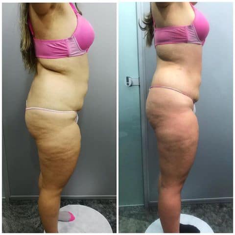 Sapphire Bellaction Duo Body & Face Remodeling Anti Cellulite Behandlung Gesäß Beine Bauch