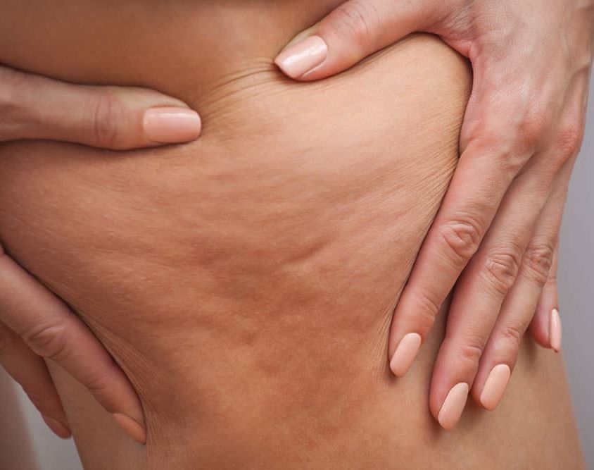 Cellulite-Behandlung - Problemzone Oberschenkel